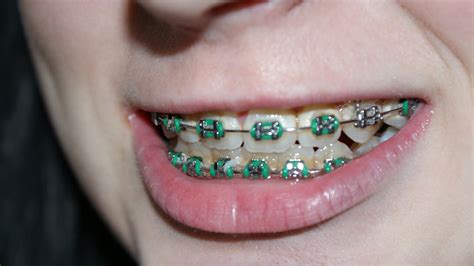 Braces Rubber Bands - Purpose, Effects, Downsides, Results