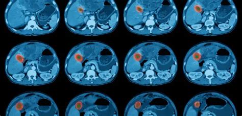 How Long Does CT Scan Results Take? - Infrared for Health