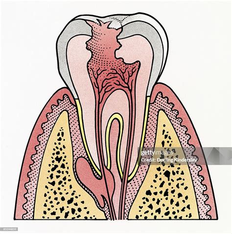 Cross Section Illustration Showing Tooth Decay High-Res Vector Graphic - Getty Images