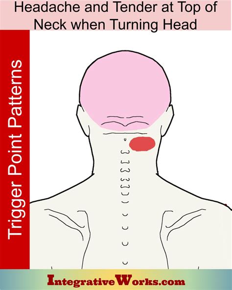 Headache with Tender Top of Neck While Turning - Integrative Works