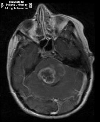 Neuroradiology On the Net: Diffuse intrinsic pontine glioma