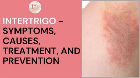 What are intertrigo symptoms and causes? - Rakshaa_clinic - Medium