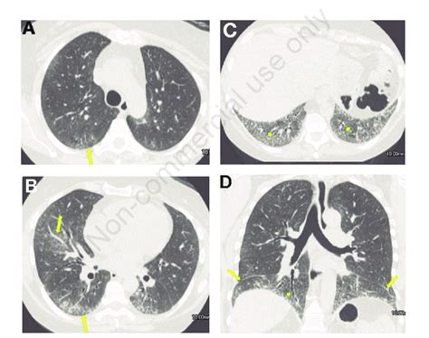 HRCT images at presentation in a patient with SSc-ILD. Axial image at ...