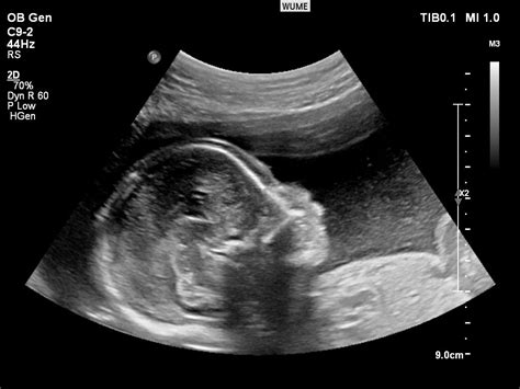 Ultrasound In Pregnancy - Women's Ultrasound Melbourne