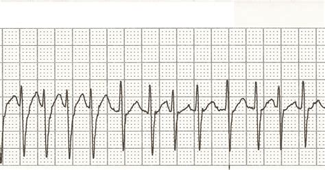 Float Nurse: EKG Rhythm Strips 16: Atrial Rhythms