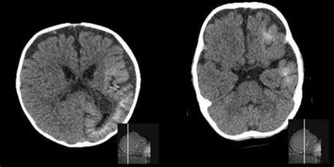 Patient Z. Sturge-Weber Syndrome. Computer tomogram of the brain ...