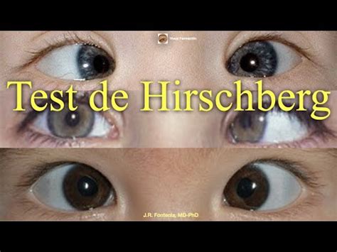 Test de Hirschberg. - YouTube