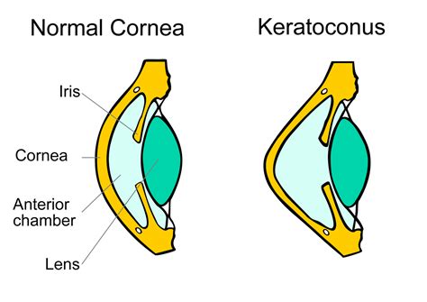 This ia what I have — A schematic diagram showing normal cornea and ...