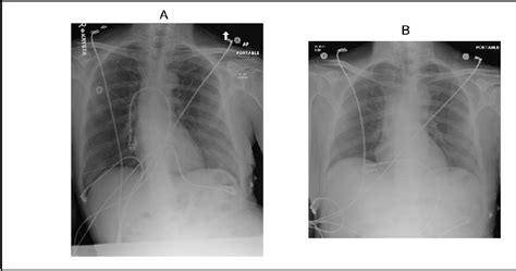 [PDF] Complications of Pacemaker Implantation | Semantic Scholar