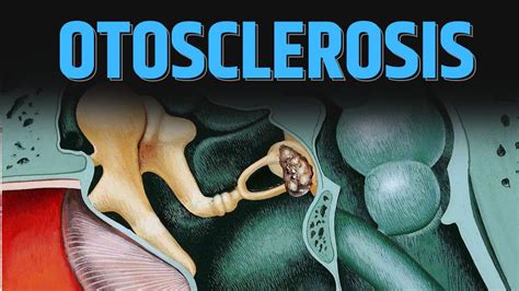 What happens in "Otosclerosis" ? - YouTube