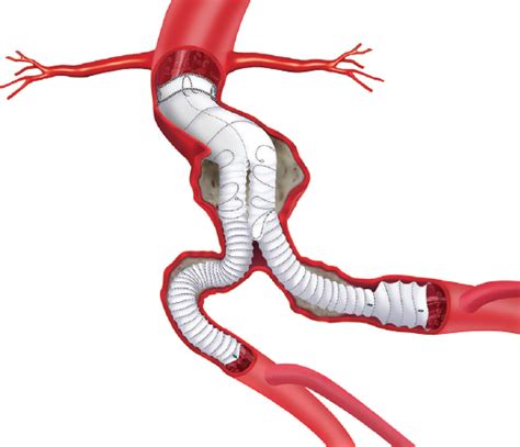 Endovascular Today - Anaconda™ AAA Stent Graft System for Challenging ...