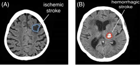 Ischemic Vs Hemorrhagic Stroke Mri