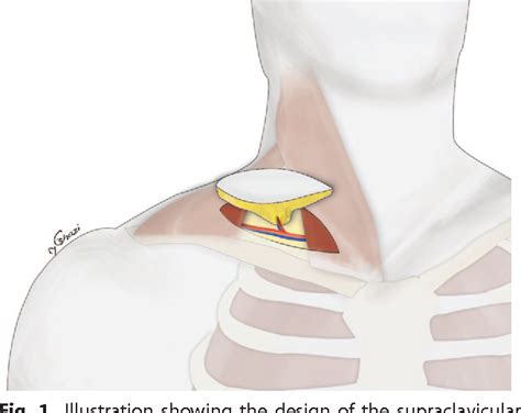 Supraclavicular lymph nodes - padjord