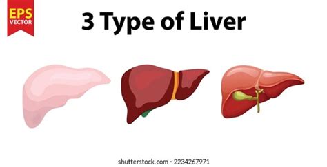 Liver Types Healthy Liver 3 Types Stock Vector (Royalty Free ...