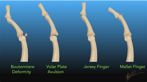 Finger Fractures | UW Emergency Radiology