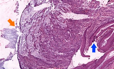 Cholesteatoma Histology