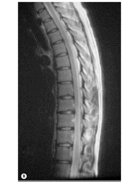 Normal Thoracic Spine Mri