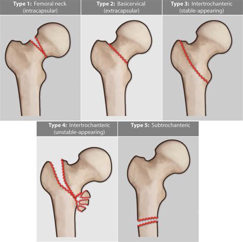 Femoral neck fracture causes, types, symptoms, diagnosis, treatment ...