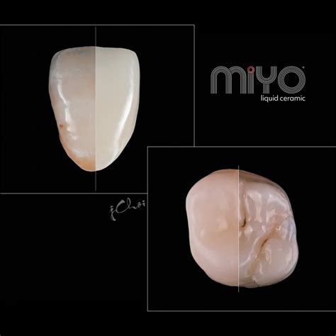 20 Reasons To Love MiYO Liquid Ceramic - Jensen Dental