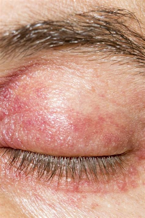 Eyelid dermatitis: Treatment, symptoms, and causes