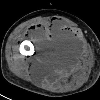 -CT-scan with intravenous injection of contrast medium showing the ...