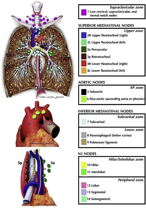 Lung Cancer Staging - Clinics in Chest Medicine