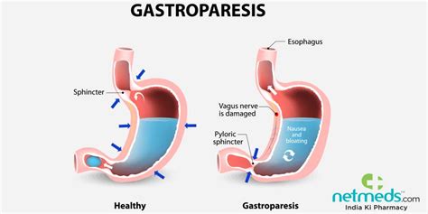 Gastroparesis: Causes, Symptoms And Treatment