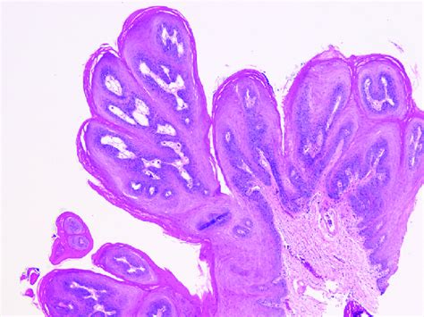 Histopathology of a squamous papilloma, low power. | Download Scientific Diagram