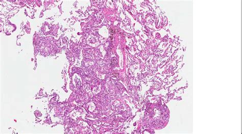 Pathology Outlines - Lipoid pneumonia