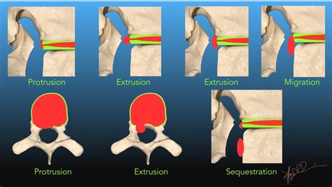 Nomenclature for Intervertebral Disc Herniation | UW Emergency Radiology