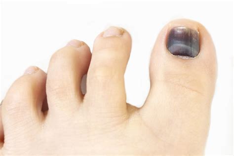 What Does It Mean When Toenail Fungus Turns Black?