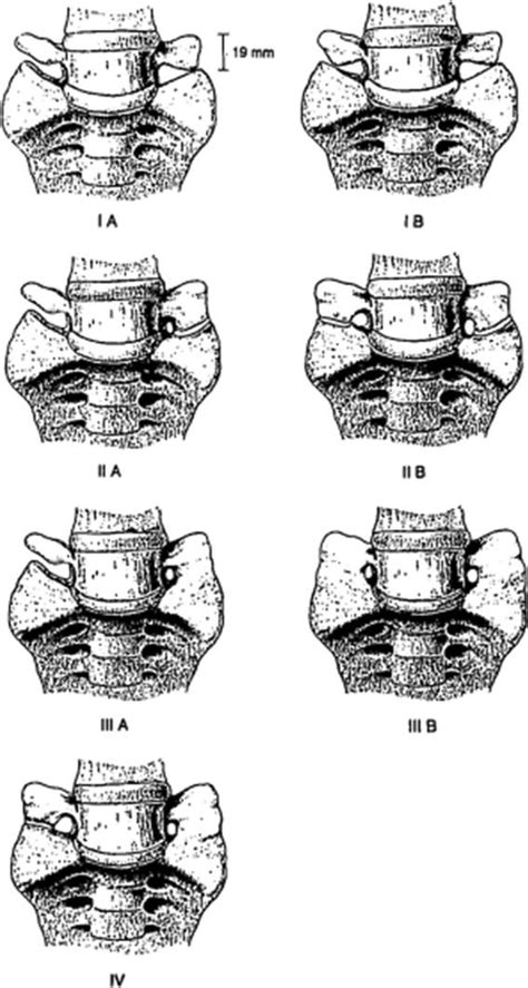 Lumbarization