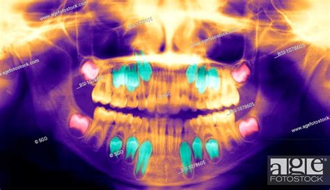 DENTAL X-RAY RESULT Dental panoramic x-ray. In red, the wisdom teeth, in turquoise, Stock Photo ...