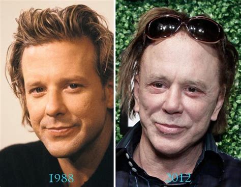 Mickey rourke plastic surgery before and after celebrity plastic ...