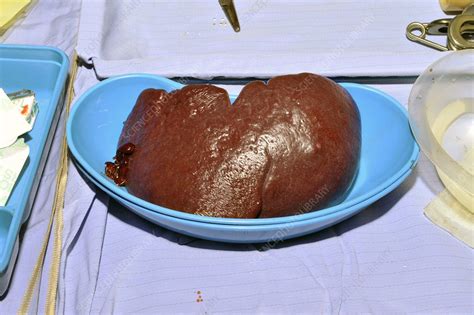 Spleen removal surgery - Stock Image - C001/8179 - Science Photo Library