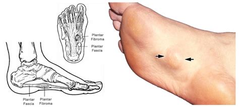 Plantar Fibroma - Ankle, Foot and Orthotic Centre