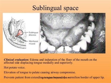 Space infection 2 /certified fixed orthodontic courses by Indian dent…