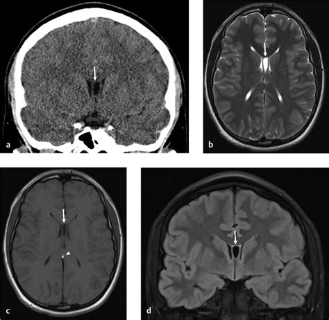 5 Cavum Septum Pellucidum | Radiology Key