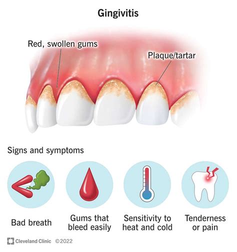 Understanding Gum Disease: Causes, Symptoms, and Treatments - Ask The ...