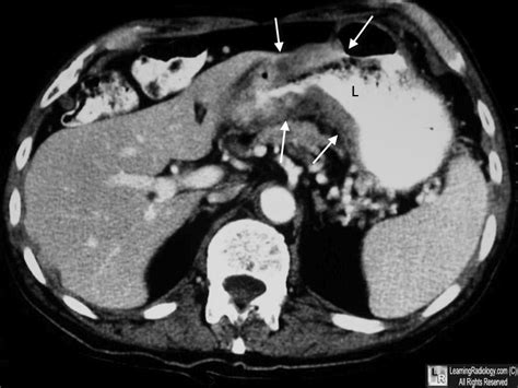 LearningRadiology - Carcinoma of the Stomach