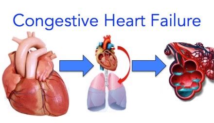 Congestive Heart Failure - Video, Symptoms, Treatment,