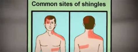 Do Home Remedies Ease Shingles Rash Pain? - The Viral Inhibitor