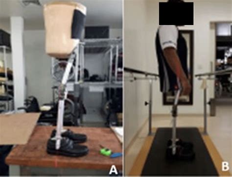 Translumbar Amputee