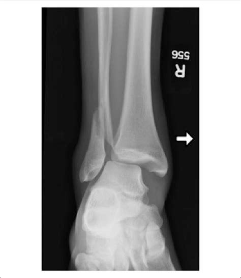 Closed bimalleolar equivalent ankle fracture with syndesmotic ...