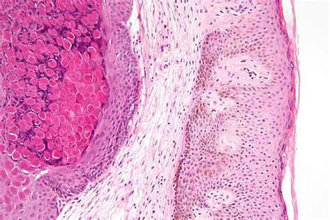 Molluscum contagiosum - Microbiology - Medbullets Step 1