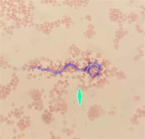 Heartworm Disease Basics