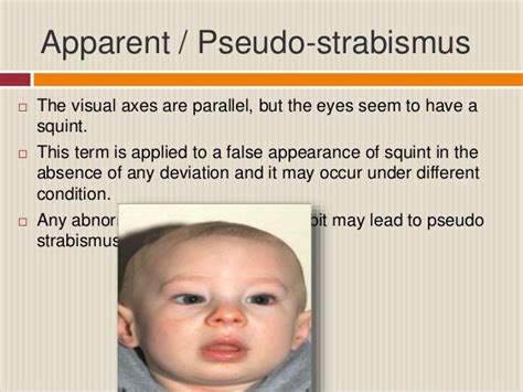 Evaluation of squint