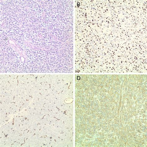 Histology images of hemangiopericytoma with different stains: (A)... | Download Scientific Diagram