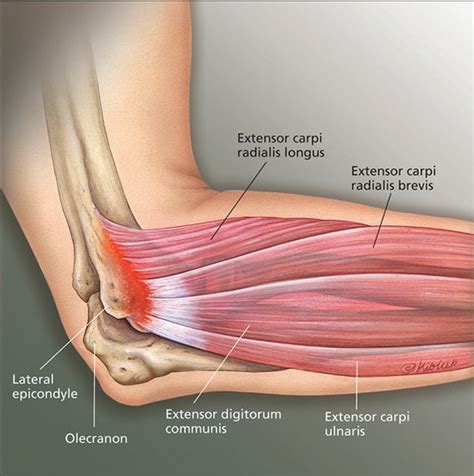 Elbow Hyperextension Injury and TFCC Tear Ulnar Side Wrist Pain