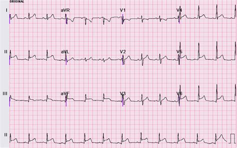 12 Lead Ecg With St Elevation